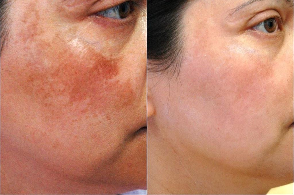Review khách hàng đã sử dụng kem trị nám, tàn nhang H2- Skin Spot Cream