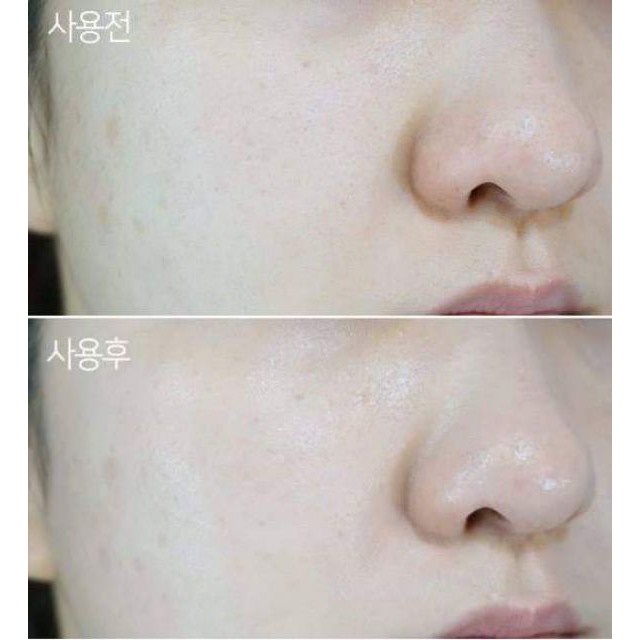 Làn da trước và sau khi sử dụng kem trị nám Camiane